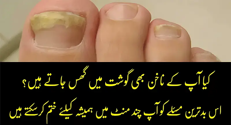 Nail Fungus Treatment at Home in Urdu