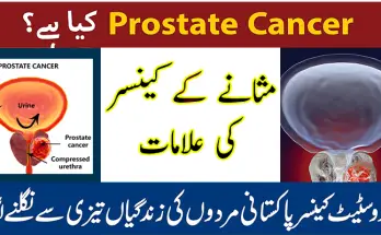 Prostate Cancer Symptoms in Urdu - Masana Ka Cancer Ki Alamat