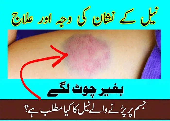 Unexplained Bruises on Arms Legs Neel Ka Nishan Waja Ilaj