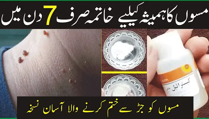 Say Goodbye to Skin Tags and Moles Naturally with Home Remedies