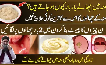 How to Get Rid of Canker Sores with Natural Home Remedies