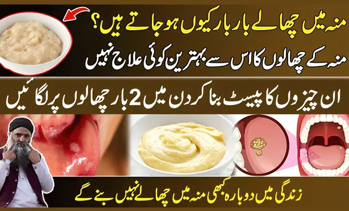 How to Get Rid of Canker Sores with Natural Home Remedies