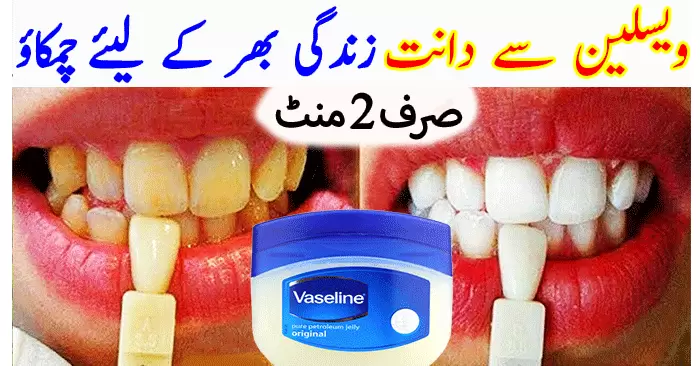  Why Teeth Turn Yellow and How to Get Whiten Teeth with Home Remedies
