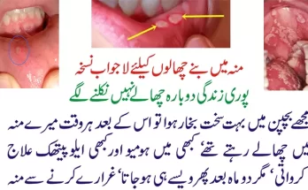 canker sores